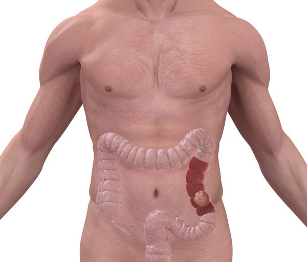 Cáncer de colon en menores de 50 años: conocé cómo evitarlo